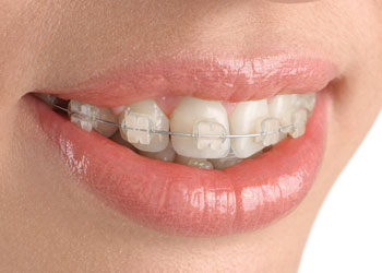 Dental Implants in Anand