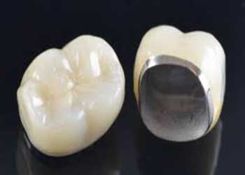 Dental Implants Anand