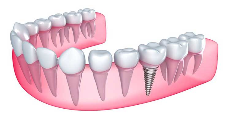 Dental Implants in Anand