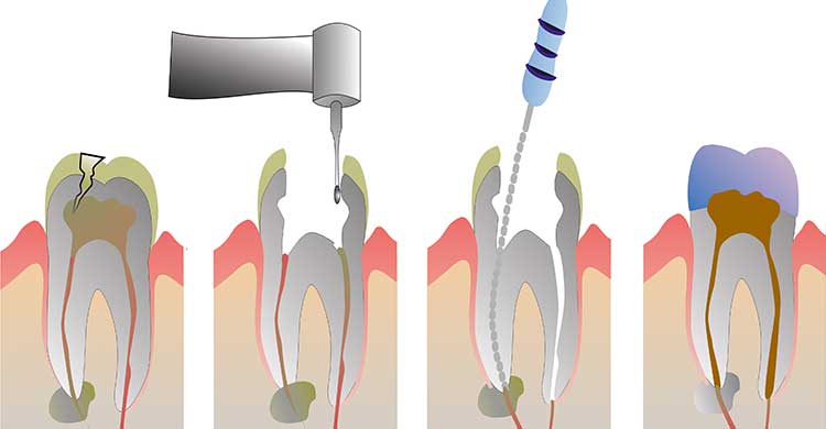 Root Canal Treatment in Anand
